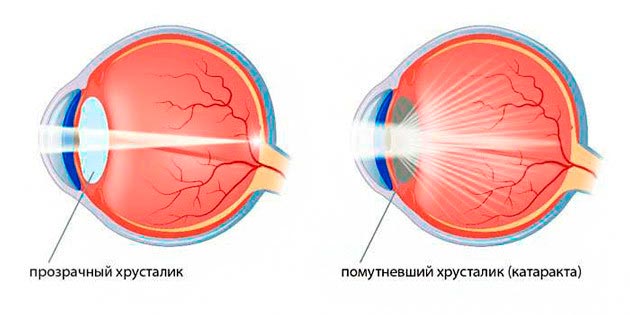 Лечение катаракты Ялта