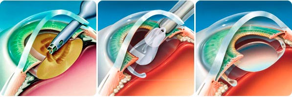 Лечение катаракты 